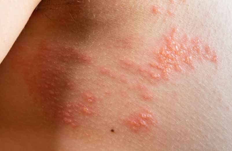 Comment prévenir les poussées et gérer l'herpès sur le long terme ?-Fitvia