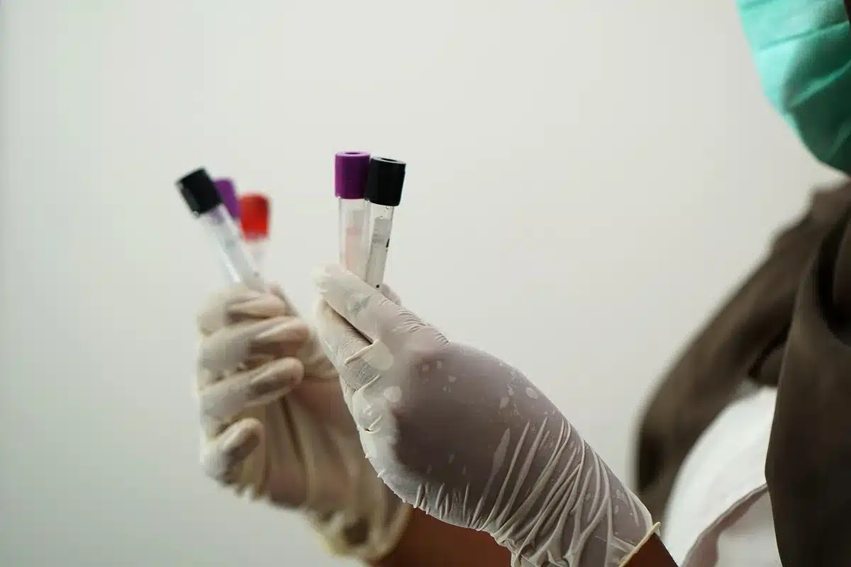 Résultat d'hémogramme montrant le champ VGM sur une feuille de laboratoire